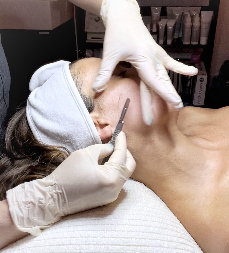 dermaplaning facial